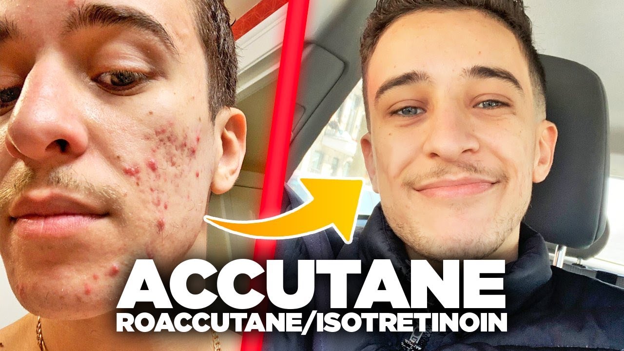 Prix Pour Isotrex