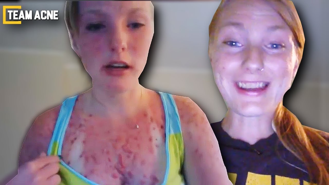 accutane online italia