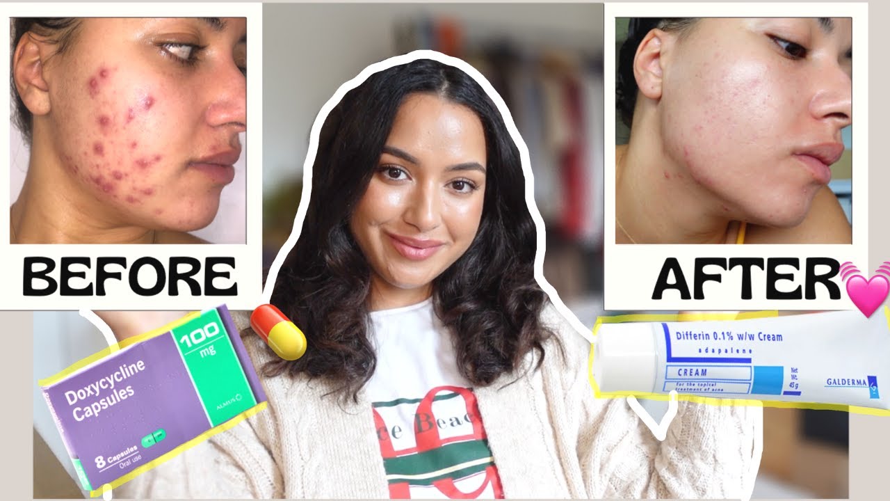 Doxycycline Acne Online