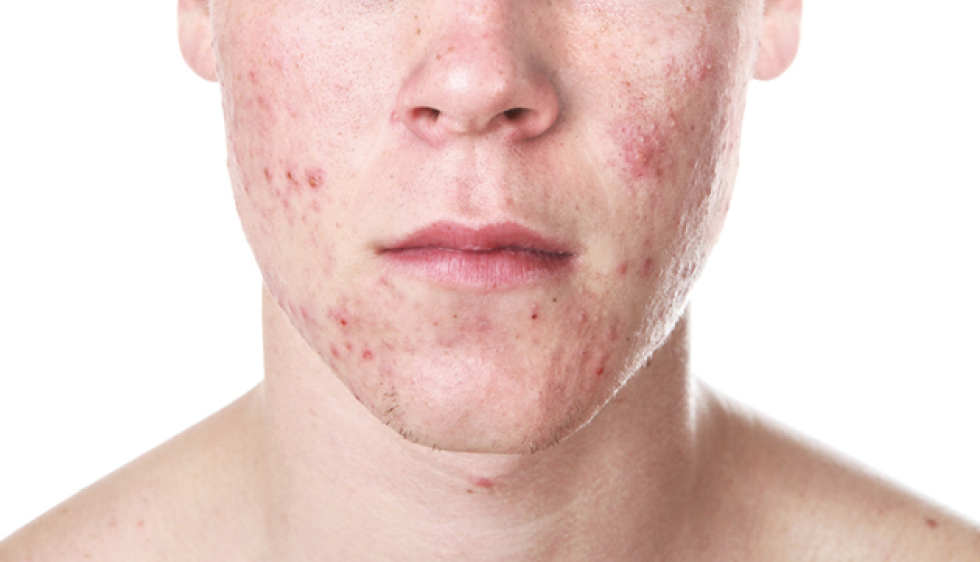 Acheter du roaccutane