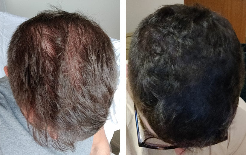 Finasteride achat france