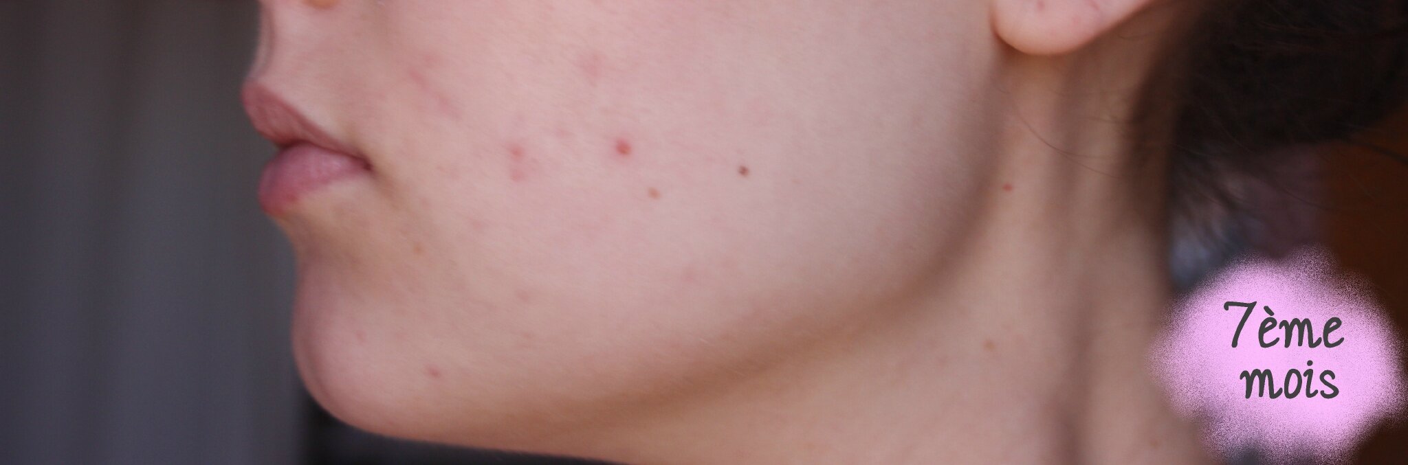 Roaccutane moins cher