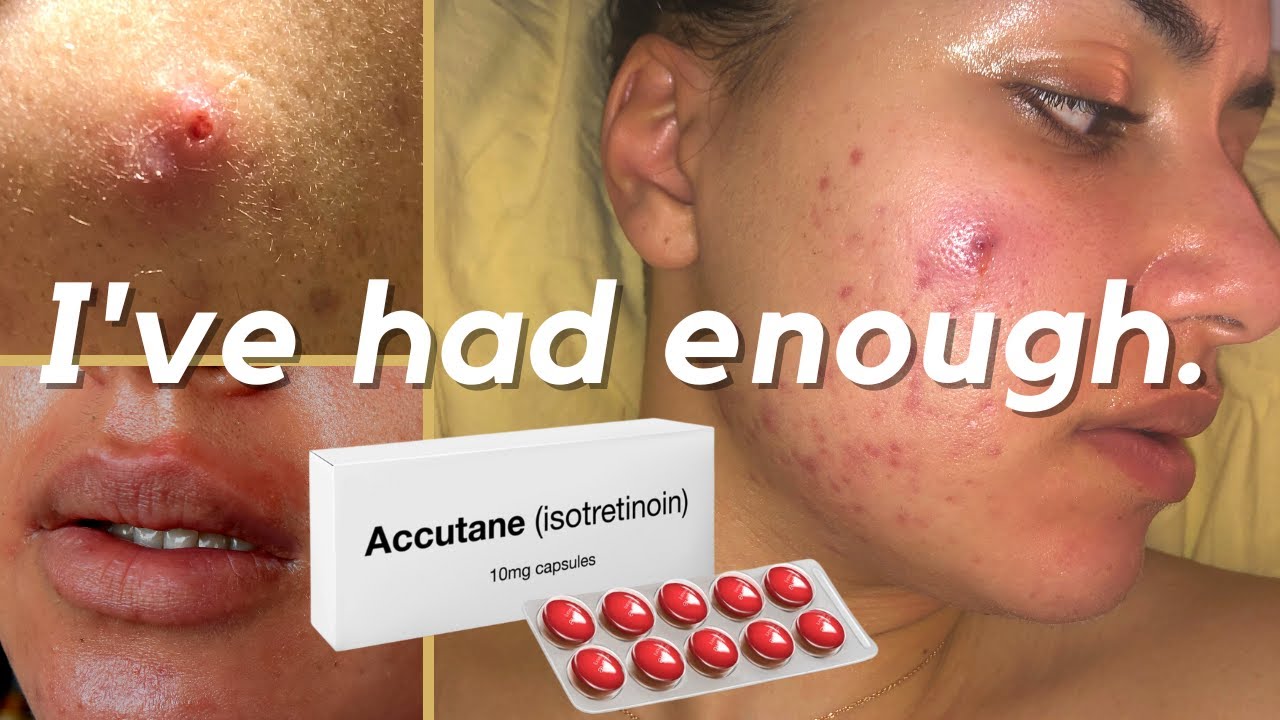 Accutane pilules