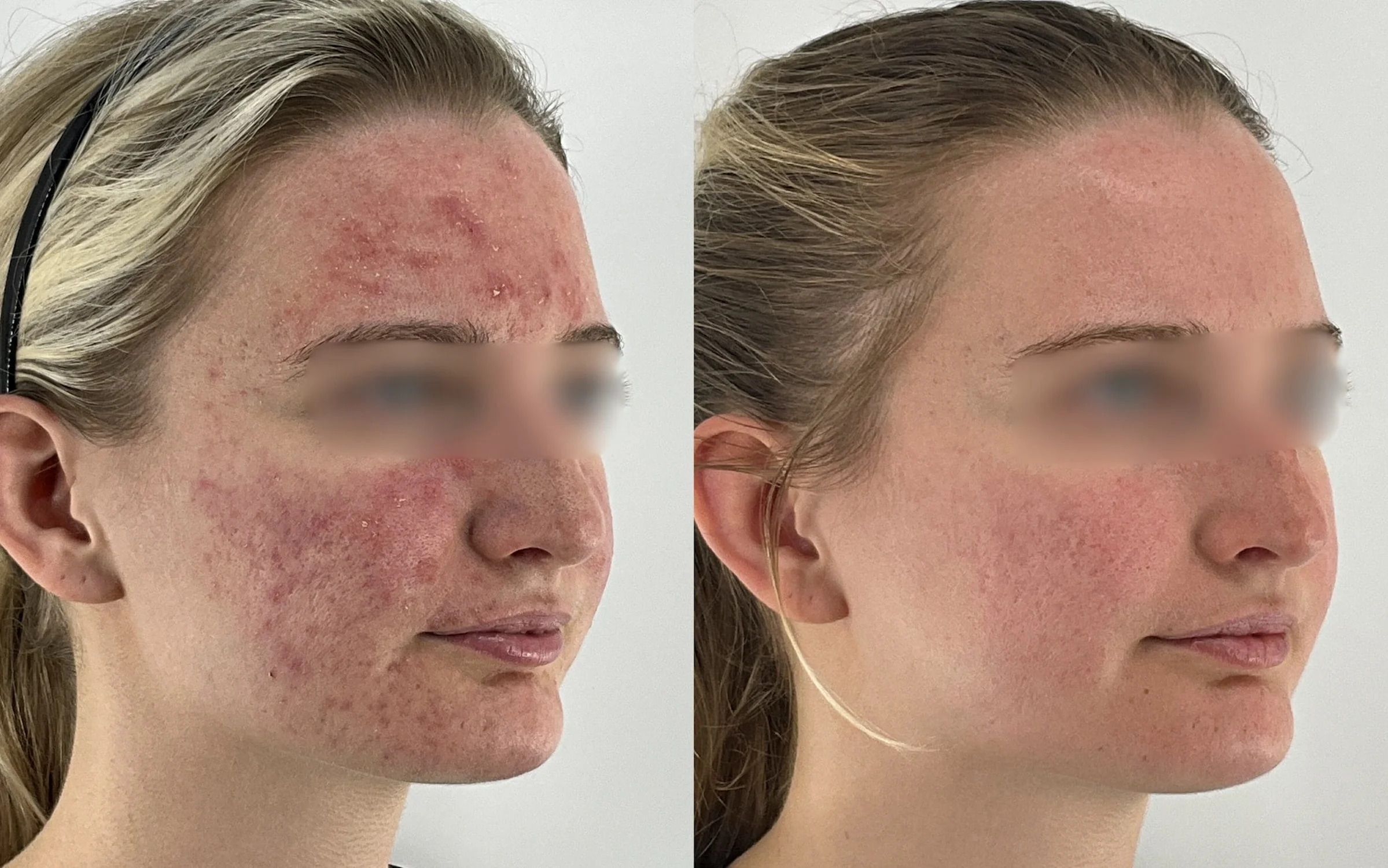 Isotretinoin France
