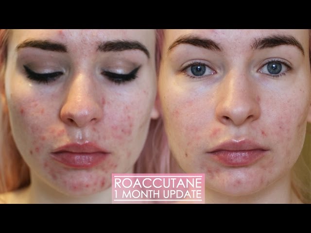 Roaccutane de 10 mg