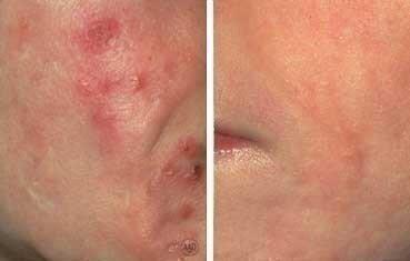 Accutane acheter online