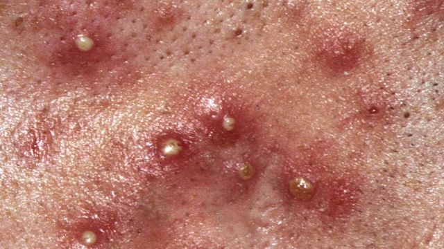 Roaccutane vente en ligne