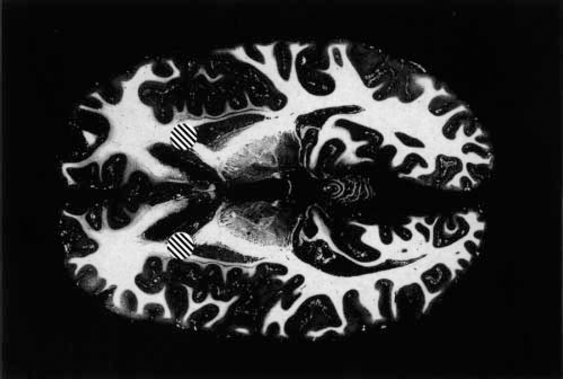 Sertraline bnf online