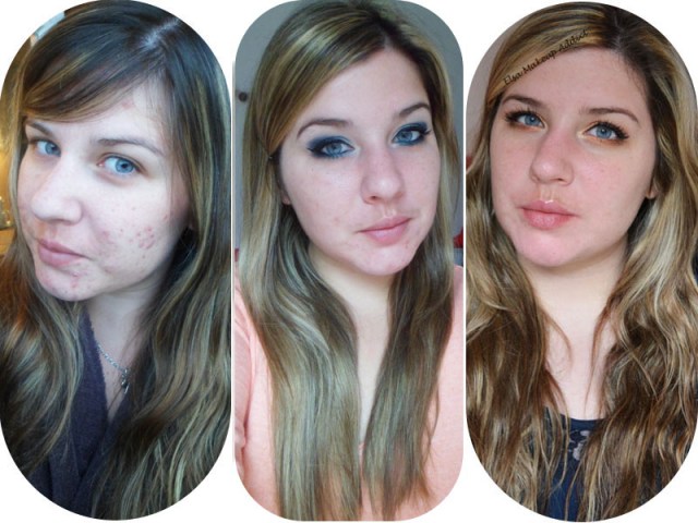 Accutane Moins Cher