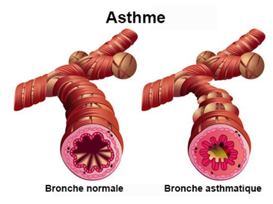 Comment Acheter Du Ventolin
