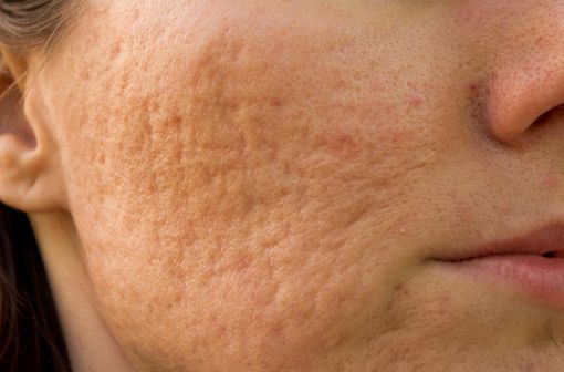 Roaccutane 40mg online