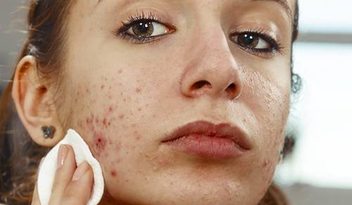 Avoir roaccutane sans ordonnance