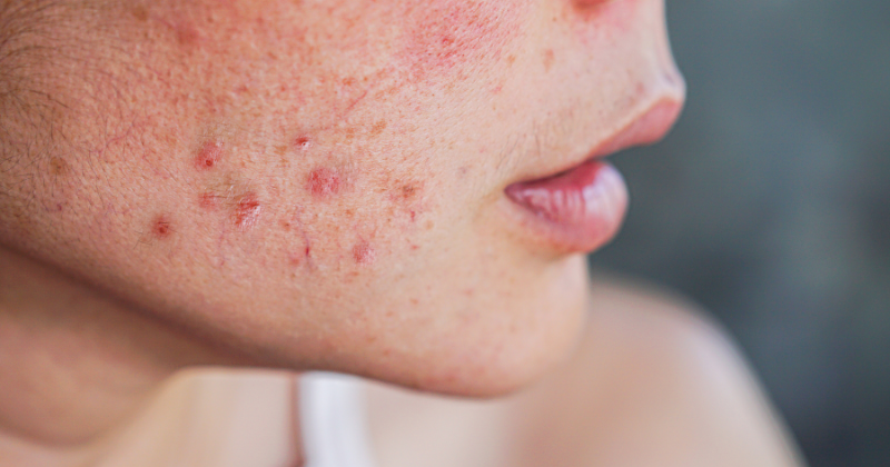 Isotretinoin Online