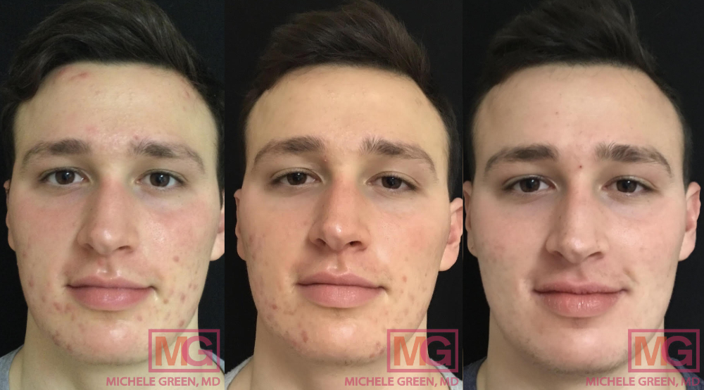 Commander accutane en ligne