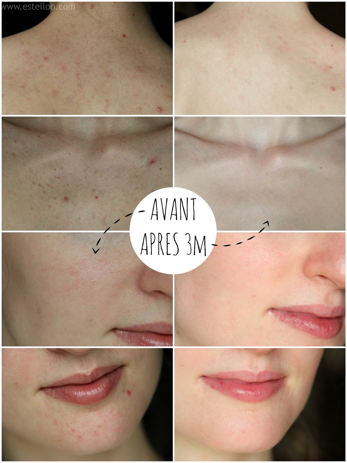 Roaccutane sans pillule