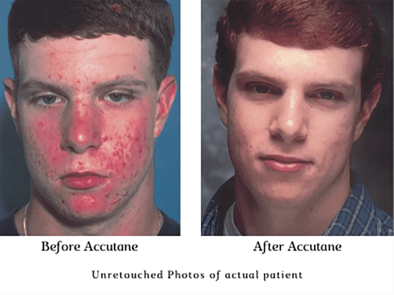 Accutane en ligne