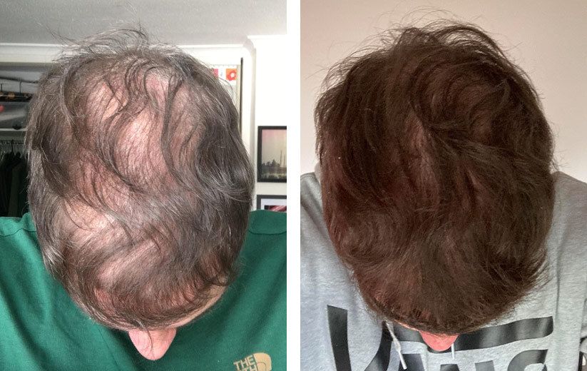 Acheter Finasteride