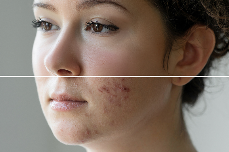 Comment acheter du accutane