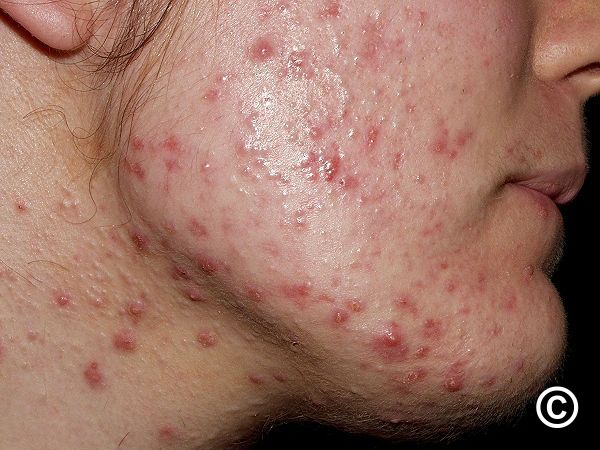Isotretinoin bnf online