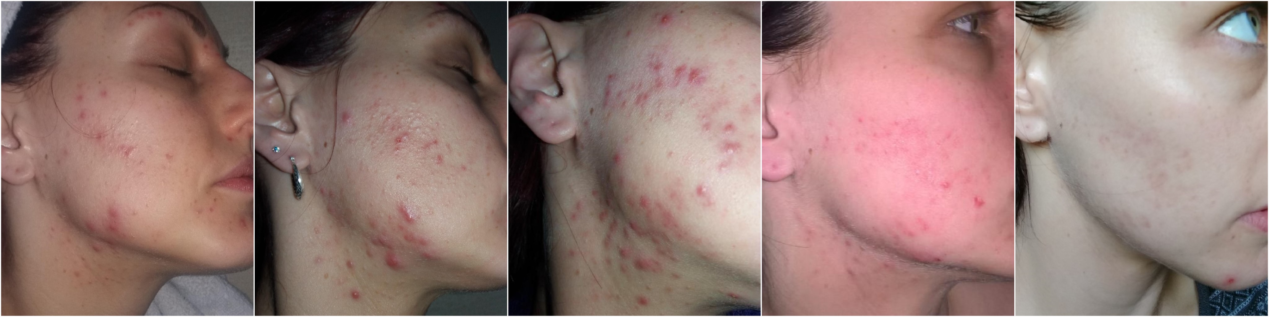Accutane 20mg online