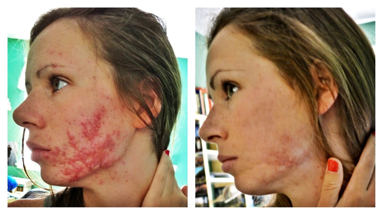 Accutane en ligne