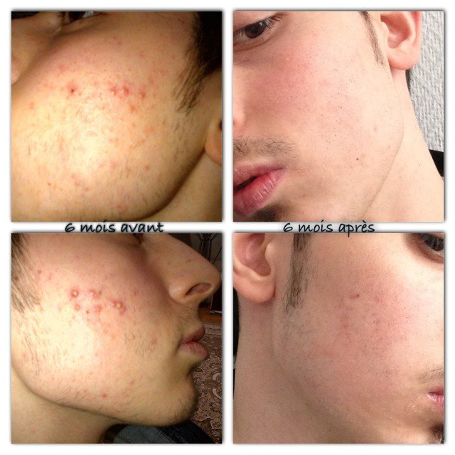 Roaccutane 30mg