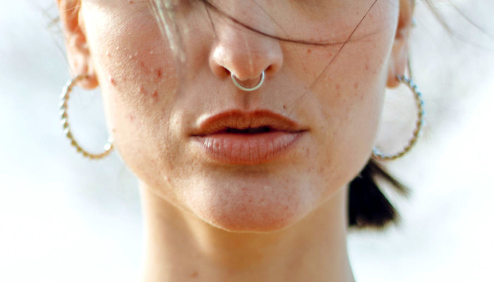 Isotretinoin gel online