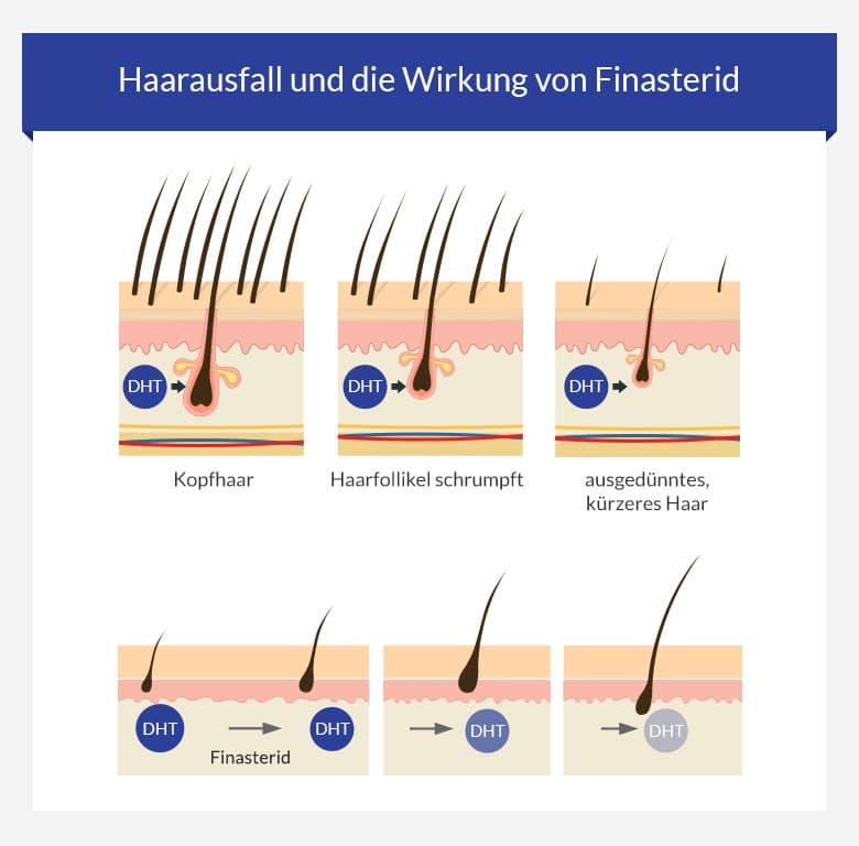 finasteride normon online