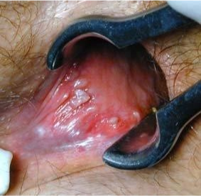Traitement Aldara Sans Ordonnance