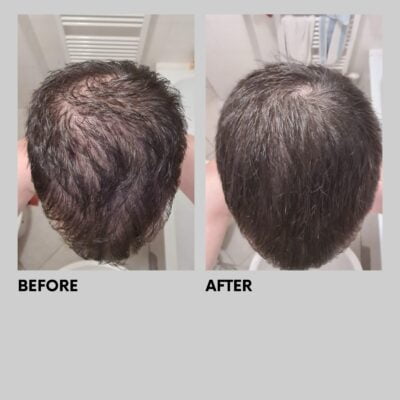 Finasteride 5 Mg France