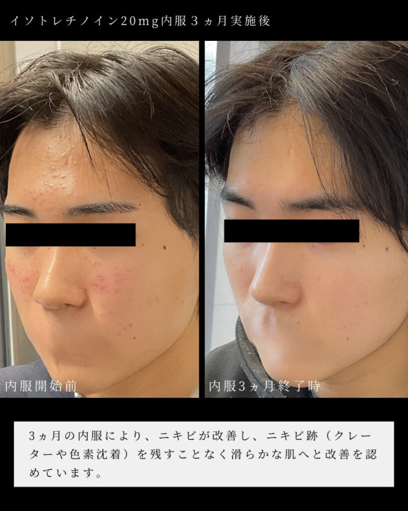 comment acheter du isotretinoin