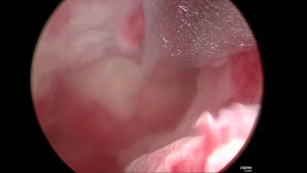 cytotec où acheter