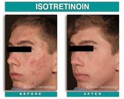 Isotretinoin gel online