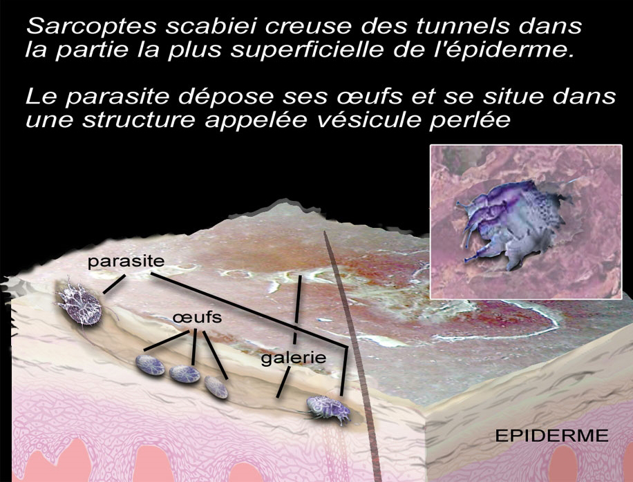 Ivermectine Crème Sans Ordonnance