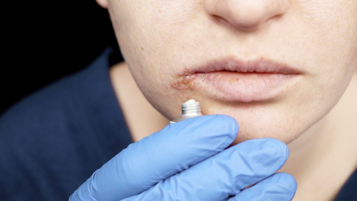 Aciclovir De 200mg Ou 400mg