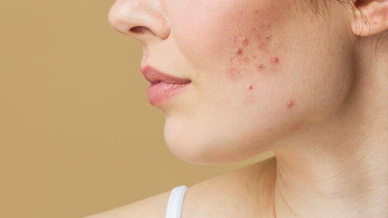 Accutane acheter sans ordonnance