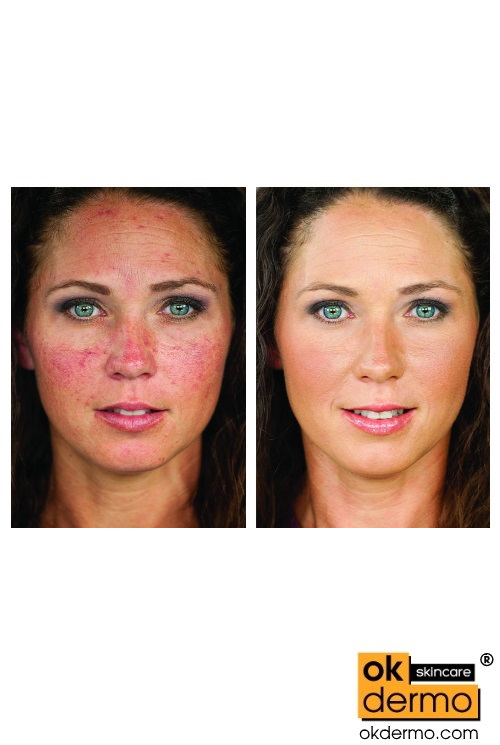 Ivermectin cream online