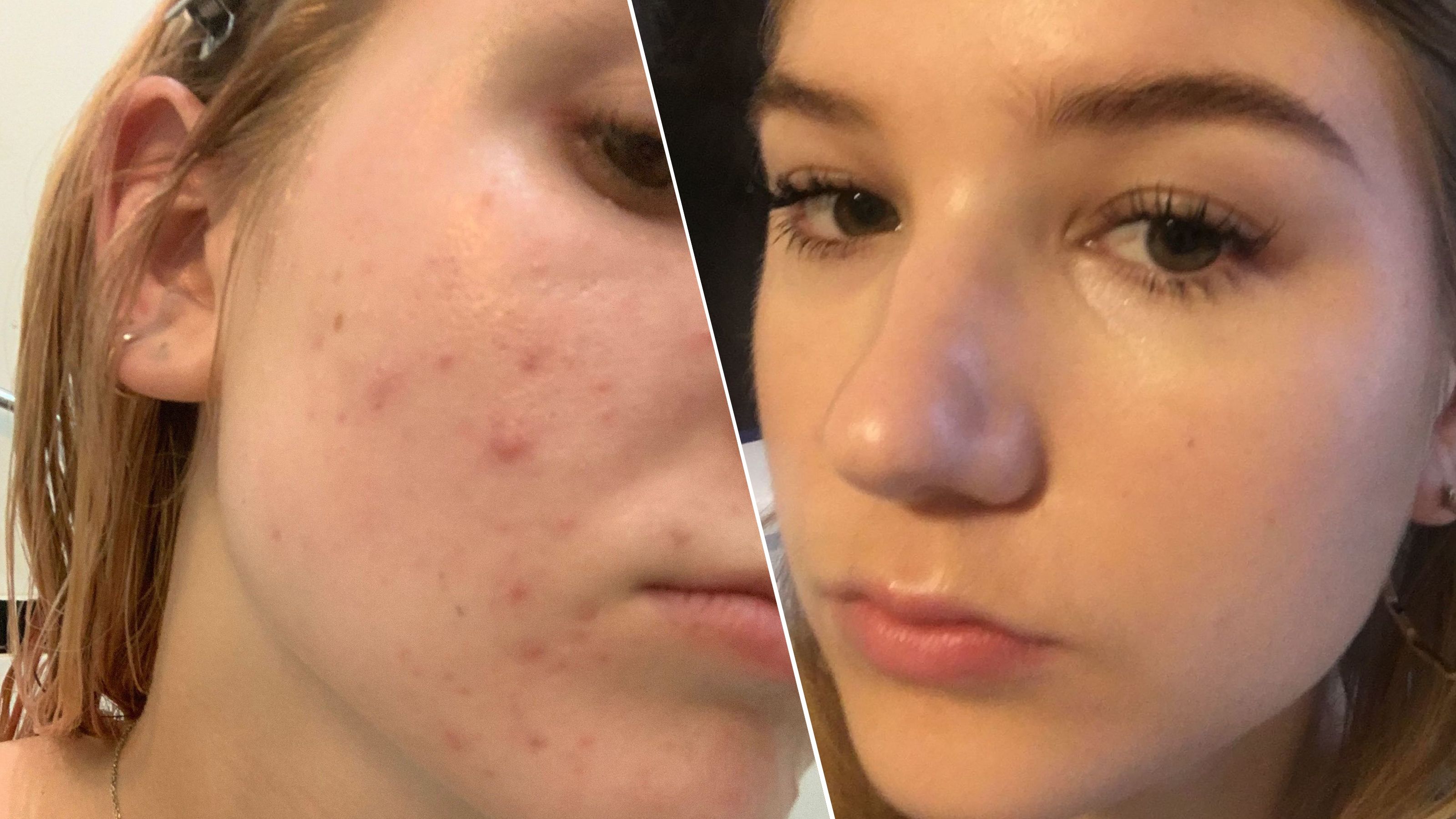 Accutane France Acheter