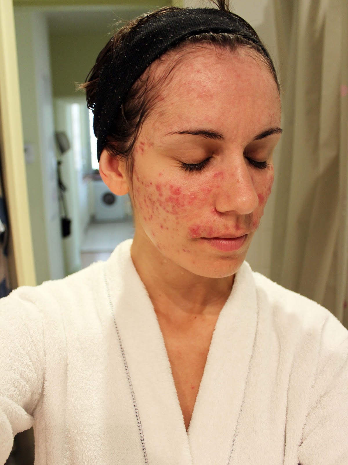 Avoir Roaccutane Sans Ordonnance