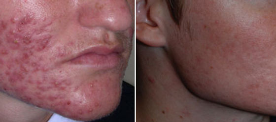 Générique de roaccutane