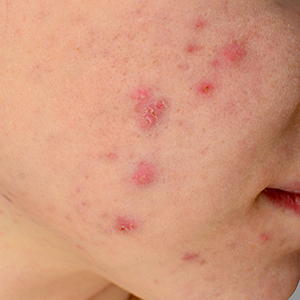 Accutane Pilule
