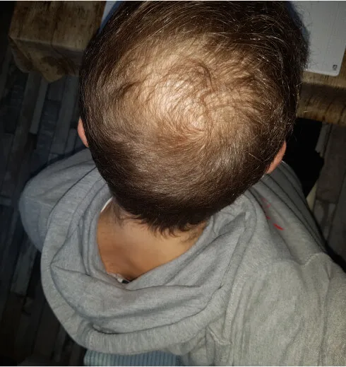 Finasteride Compra Online