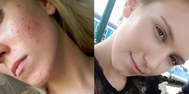 Accutane 40mg Online