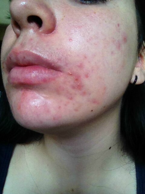 Comment Acheter Du Roaccutane