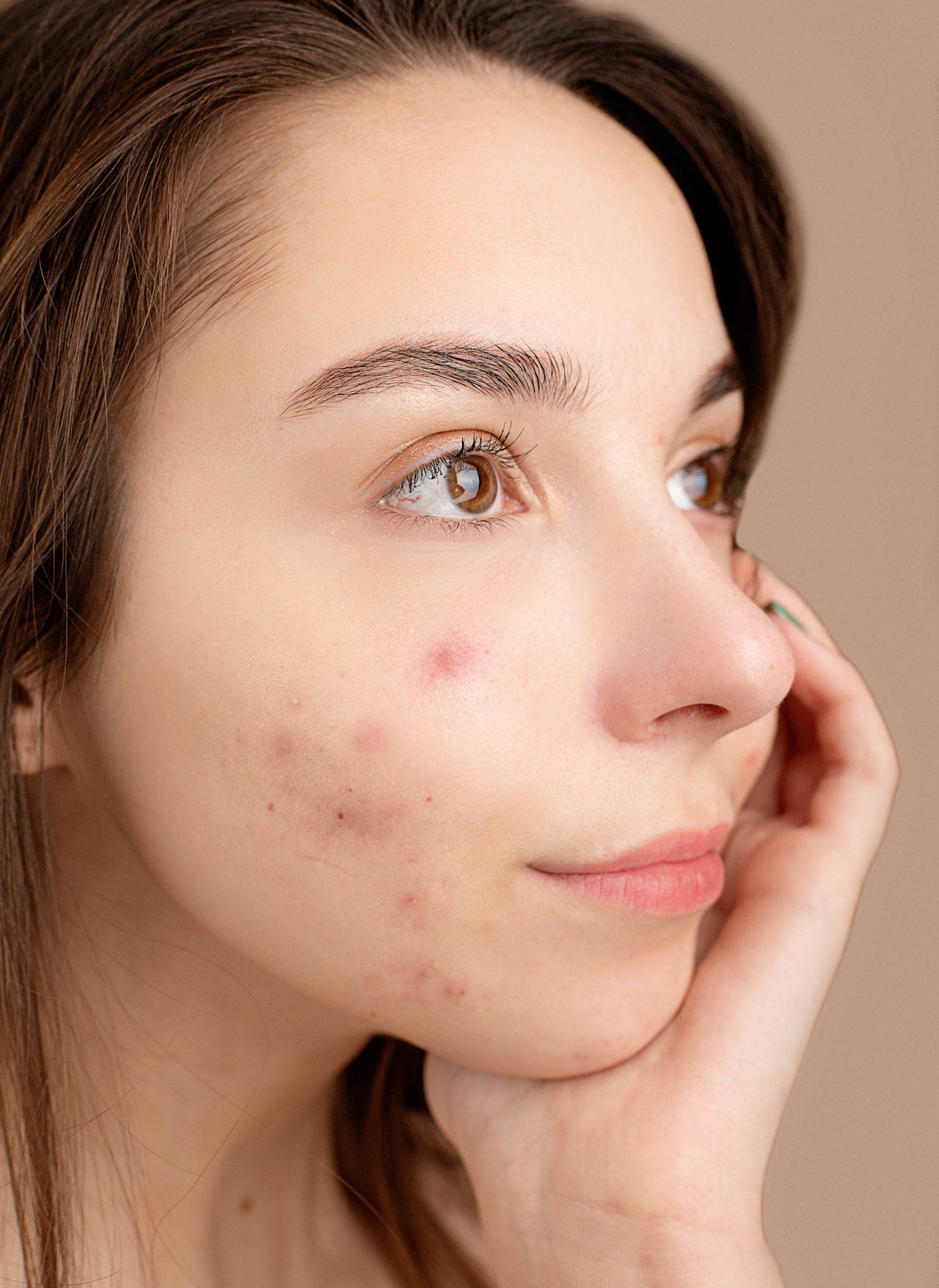 Achat de accutane