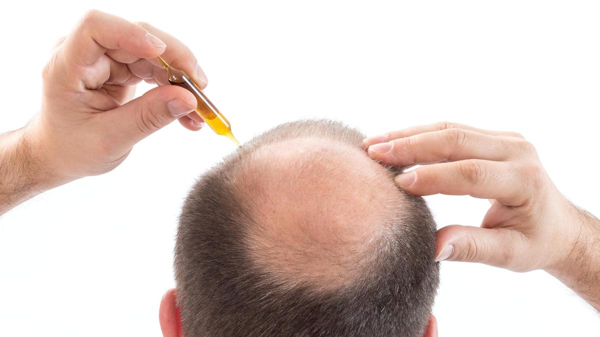 finasteride finpecia 1mg