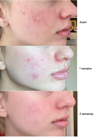 Prix Du Roaccutane