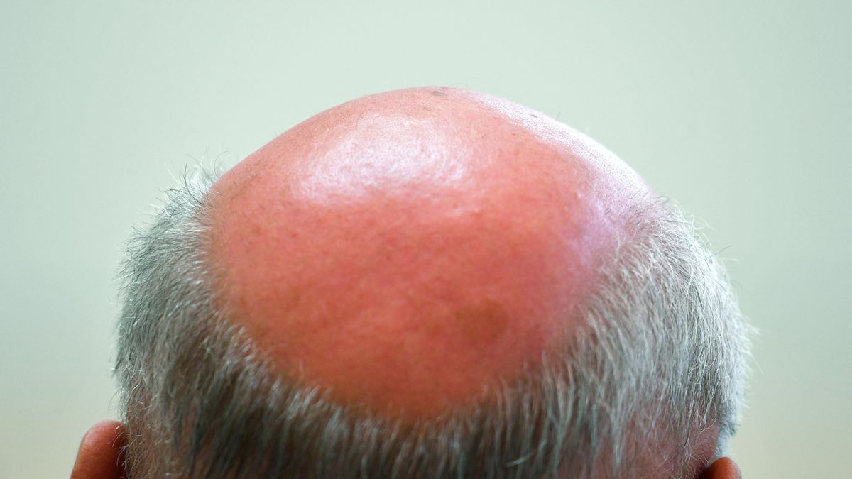 Finasteride Online Europe