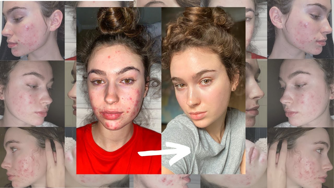 Coût Accutane