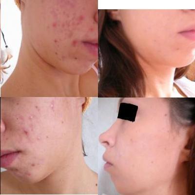 Roaccutane 5mg